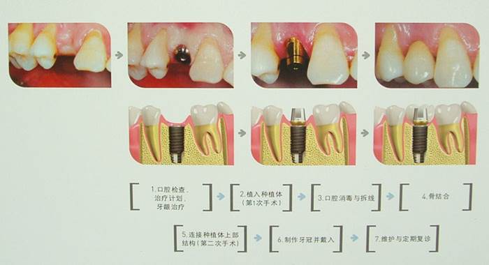 种植牙的诊断与治疗过程